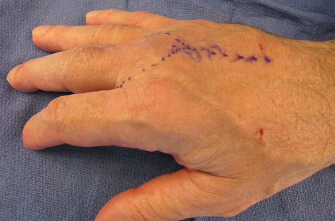 Chondrosarcoma with dorsal excision marked for ray resection.