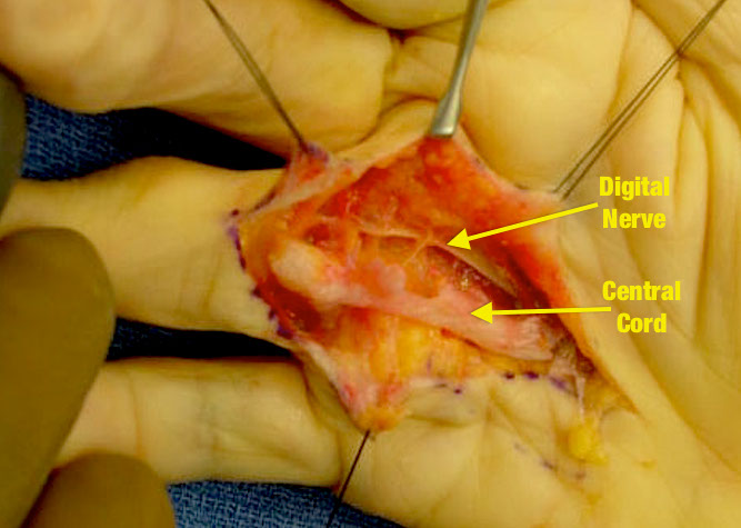 Central cord and digital nerve