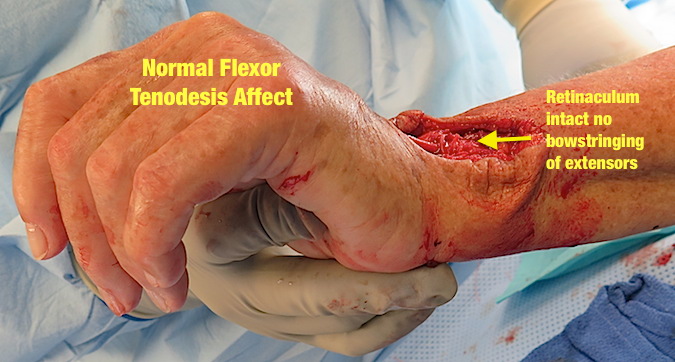 Flexor tenodesis now intact