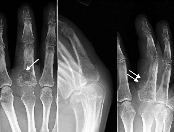 CHONDROSARCOMA | Hand Surgery Resource