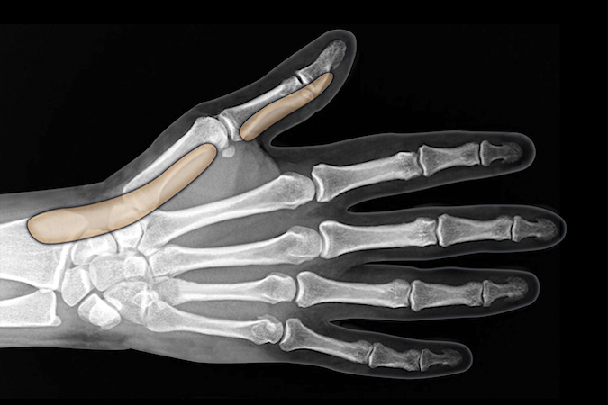 Thumb flexor tendon sheath shown separate but is connect to the radial bursa at the MP joint level and extends proximal to the transverse carpal ligament.