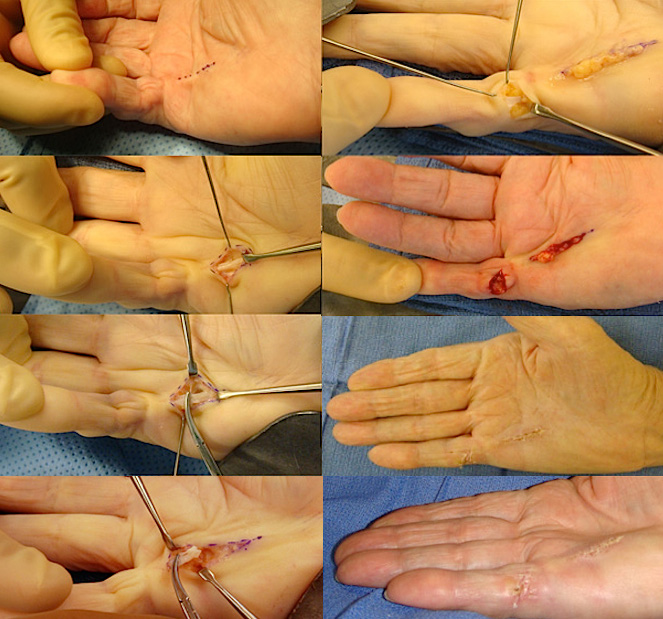 Segmental fasciectomies of a Dupuytren's central cord