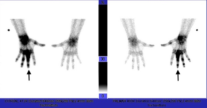 CHONDROSARCOMA | Hand Surgery Resource