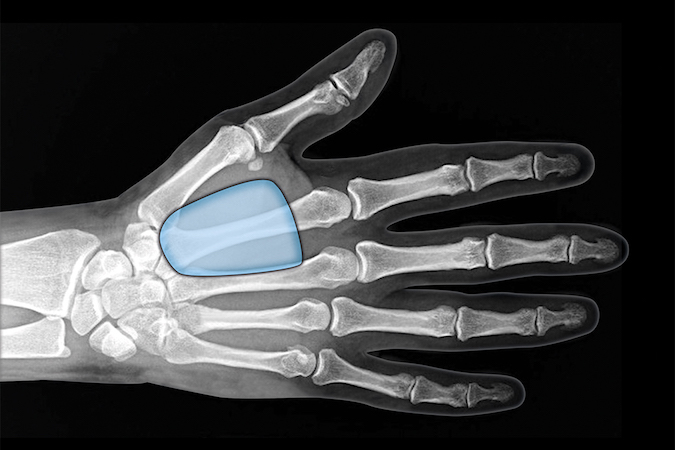 The thenar space is the index flexor sheath and the adductor pollicis fascia. Infection can spread here from the index flexor tendon sheath or from puncture wounds.