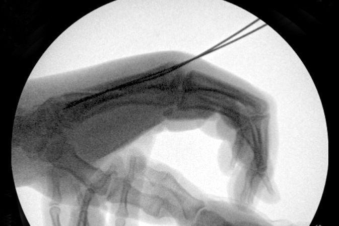  Long and ring spiral oblique metacarpal fractures (Lateral view) undergoing closed reduction and percutaneous pinning.