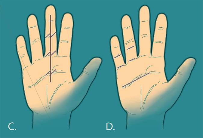 Dupuytren's Incisions - Second two common patterns out of many choices