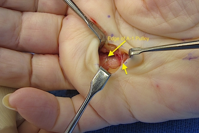 Edge of A-1 exposed. Second arrow at fiber of palmar aponeurotic pulley (superficial intermetacarpal ligaments).