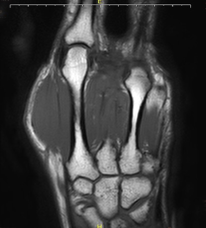 MRI after ray resection with no signs of recurrence.