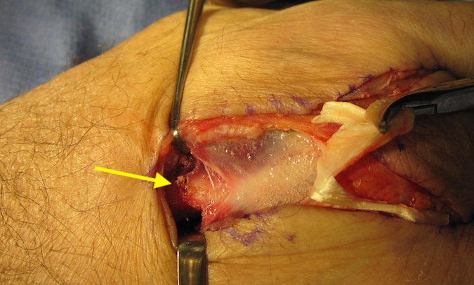 CHONDROSARCOMA | Hand Surgery Resource