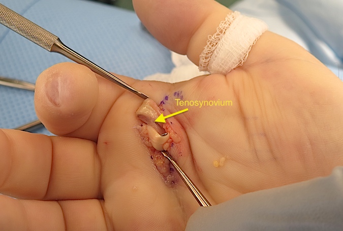 Tensynovium between FDS and FDP which sometimes thickens and requires excision to fully relieve catching and locking with active motion.