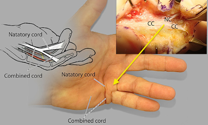 "Y" Cord (Combination of a central cord and a natatory cord) to the ring and little fingers.