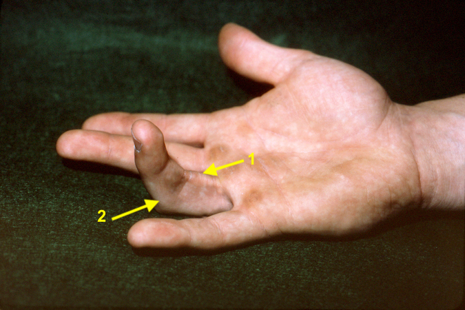 A-2 PULLEY RUPTURE (FLEXOR TENDON SHEATH RUPTURE) | Hand Surgery Resource