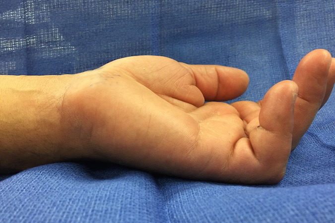 A-2 PULLEY RUPTURE (FLEXOR TENDON SHEATH RUPTURE) | Hand Surgery Resource