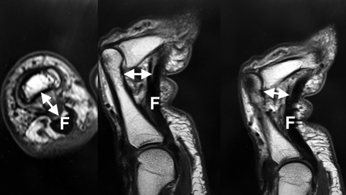 A-2 PULLEY RUPTURE (FLEXOR TENDON SHEATH RUPTURE) | Hand Surgery Resource