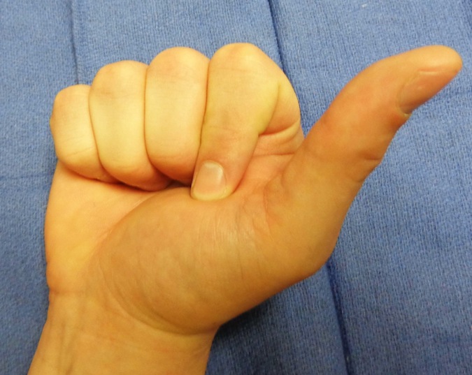 ANTERIOR INTEROSSEOUS NERVE PALSY | Hand Surgery Resource