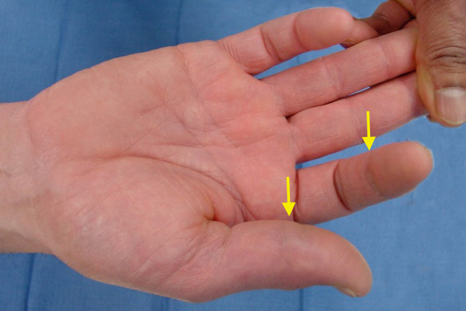 Anterior Interosseous Nerve (AIN) Sign | Hand Surgery Resource