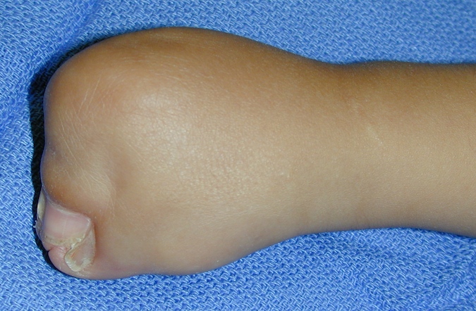 Apert's Syndactyly