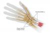 The brachioradialis has been released from its insertion site at the radial styloid. The FPL has been transacted at the musculotendinous junction. Next the FPL has been sutured into the brachioradialis tendon. 