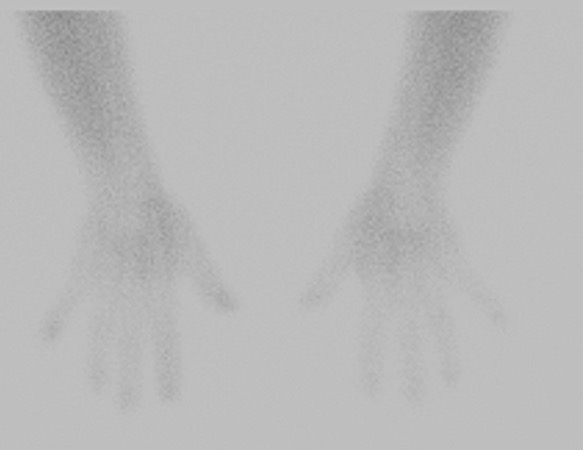 Normal, 3 phase bone scan with no focal uptake within the osseous structure to suggest pathology