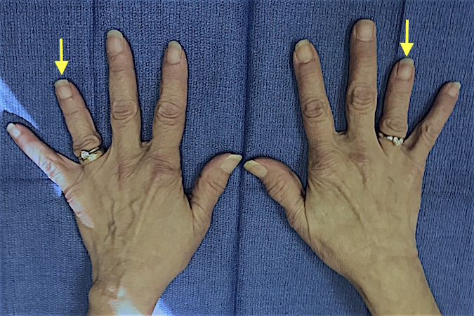 Brachydactyly - Short 4th Metacarpal (arrows)