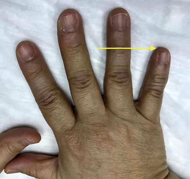 Brachydactyly Fifth Finger