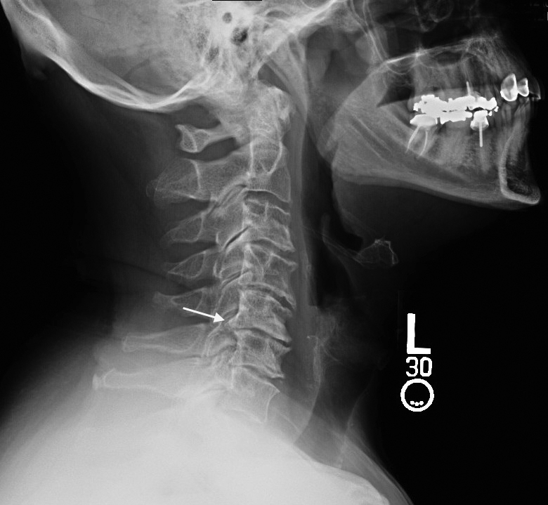 Significant Cervical Osteoarthritis and Disc space narrowing. Note large posterior osteophytes(arrow).