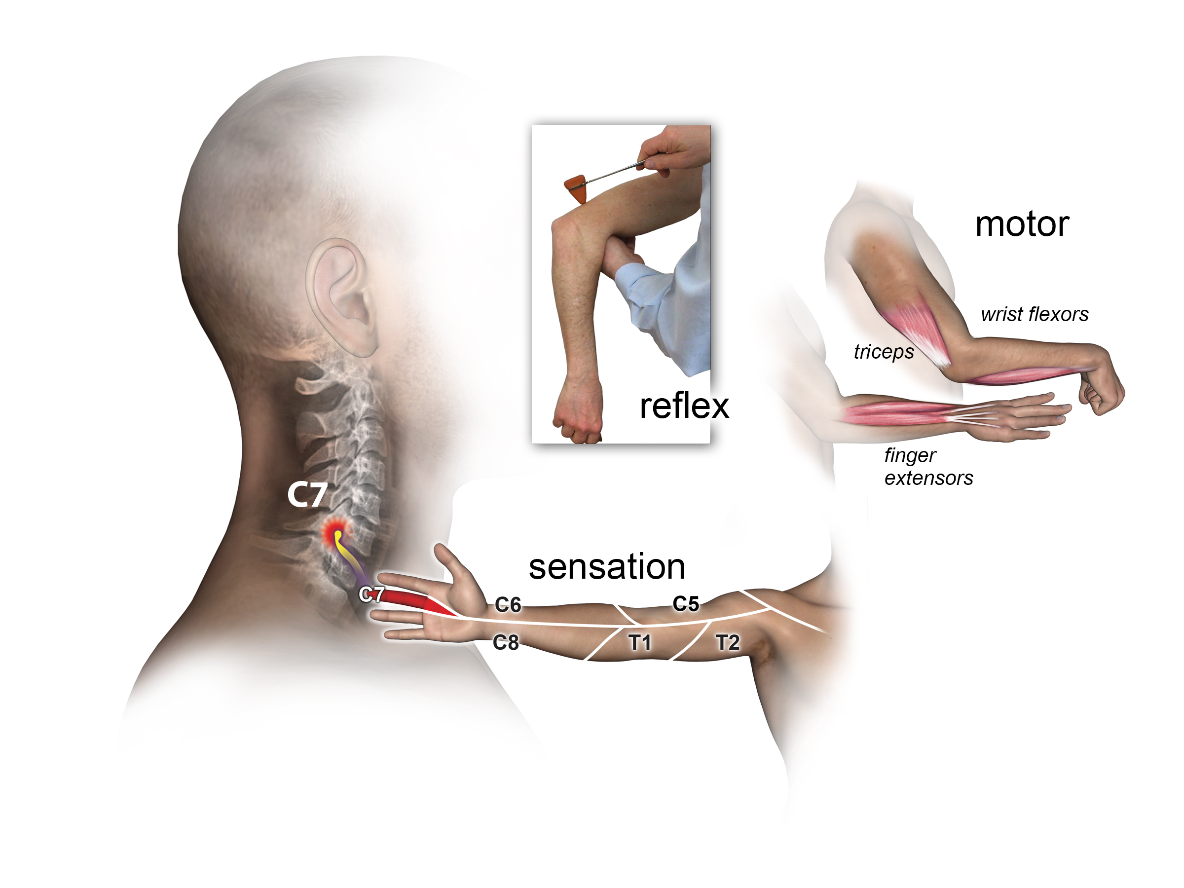 Motor, sensory and triceps reflex exam for C7 Root