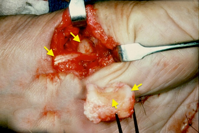 OSTEOARTHRITIS, CARPOMETACARPAL (CMC) JOINT OF THUMB | Hand Surgery ...