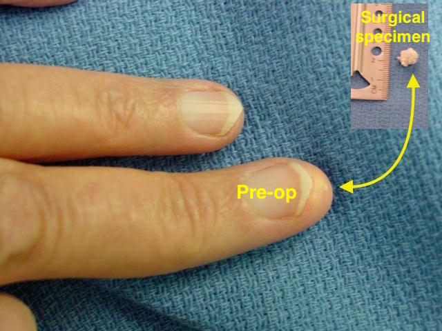 Painful calcific lesion long finger tip and excised specimen