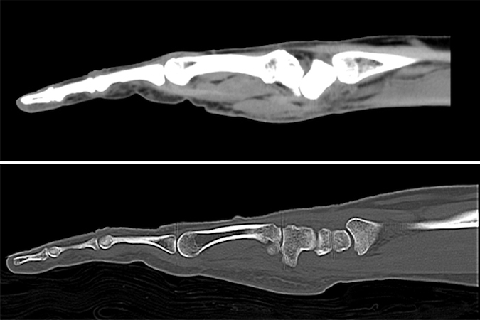 Soft tissue window (Top) and bone window (Bottom)