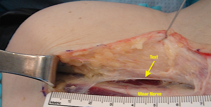 Cubital Tunnel Syndrome- Note edge of intramuscular Septum. A section of this should be removed when doing anterior transposition of the ulnar nerve