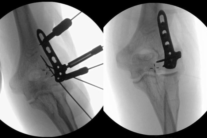 ORIF of left adult capitellar/medial epicondylar fracture.