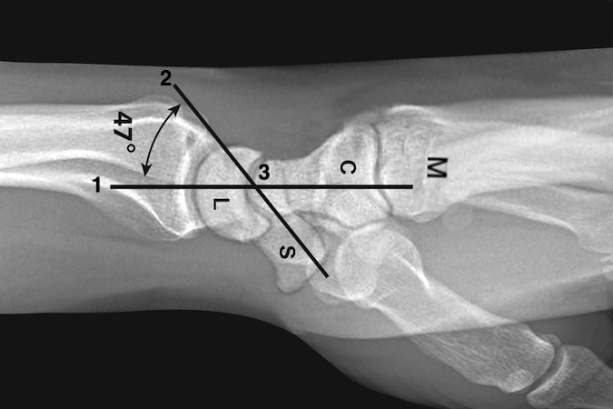 DISLOCATION, WRIST RADIOCARPAL | Hand Surgery Resource