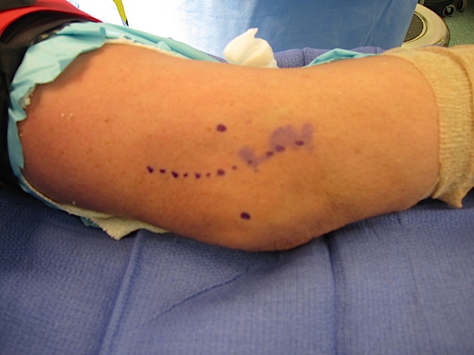 Carposcope Ulnar Neurolysis Incision