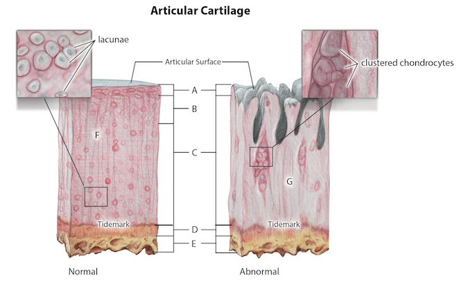 Normal and abnormal cartilage histology; A = Superficial zone; B = Transitional zone; C = Radial zone; D = Calcified zone; E = Cancellous bone; F = Cartilage matrix; G = Necrotic tissue with clustered chondrocytes