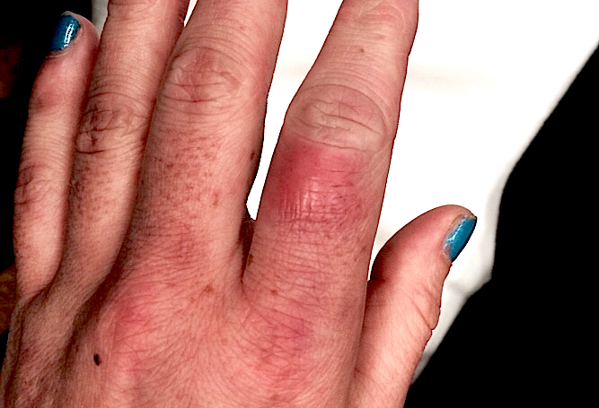 CELLULITIS | Hand Surgery Resource