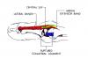 Complex PIP Dislocation by Collateral Ligament: the mechanism of injury stops after the collateral (blue) ruptures off the middle phalanx and folds itself into the PIP joint and thus blocks a closed reduction without tear or displacement of the lateral band.