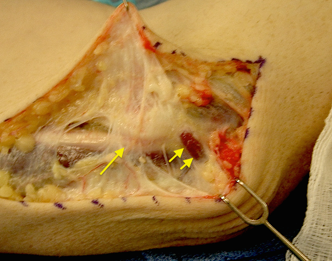 Cubital Tunnel-single arrow Osborne's ligament & double arrow E. Muscle