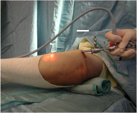 Ulnar neurolysis using arthroscope