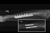 Left severely angulated double bone forearm fractures in a teenager after ORIF with plates and screws