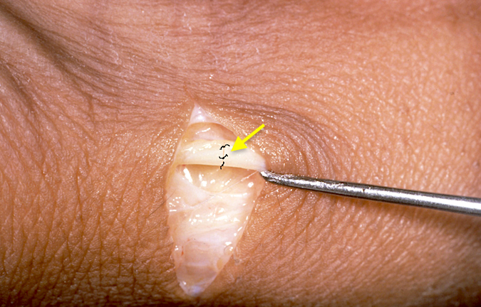 Dorsal radial sensory nerve laceration (arrow) after epieneural repair.