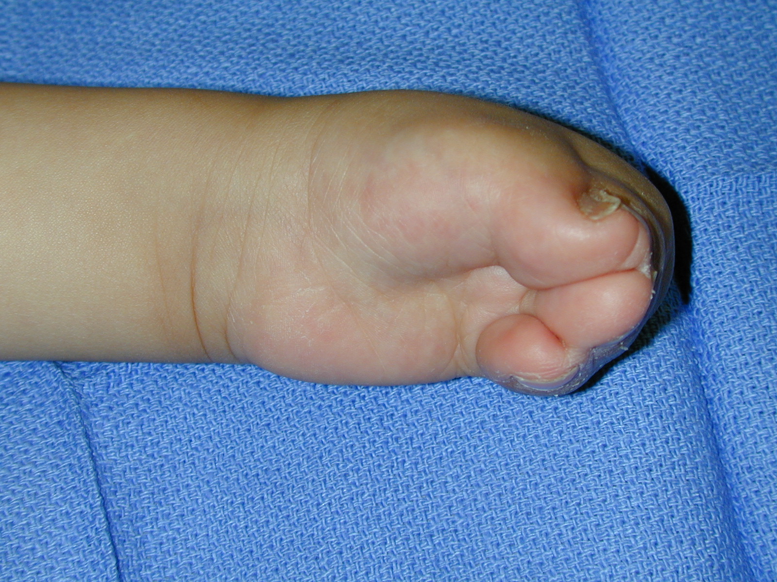 Apert's Syndrome Left Hand palm