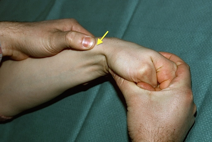 Traditional Finkelstein's Sign - Thumb is placed in palm, fingers