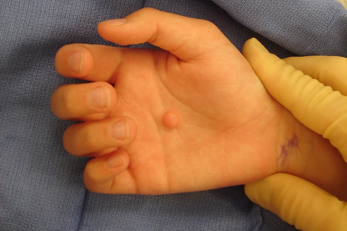 Dermatofibroma right palm