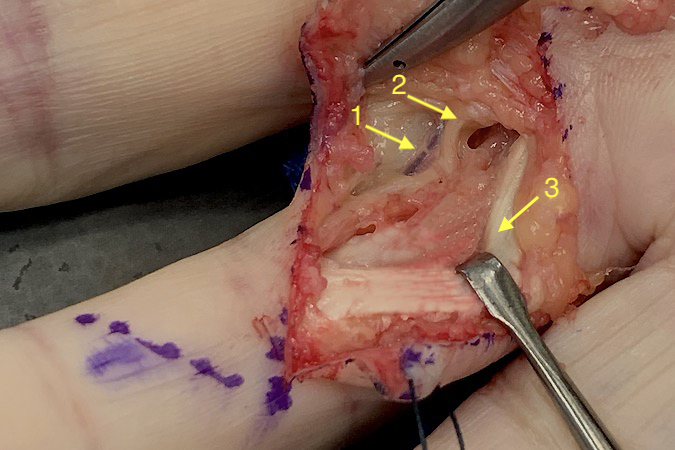 Patient cut her finger on a broken drinking glass. Lacerated and thrombosed digital artery (1); lacerated digital nerve (2); Flexor tendon (3).