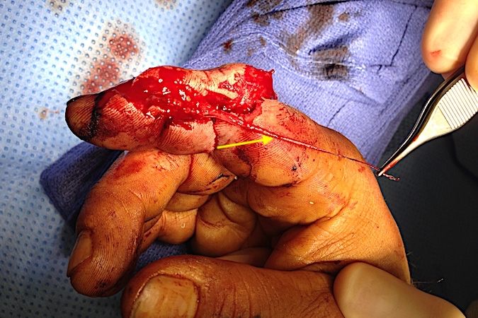 Unrepairable index radial digital nerve avulsion injury (arrow)