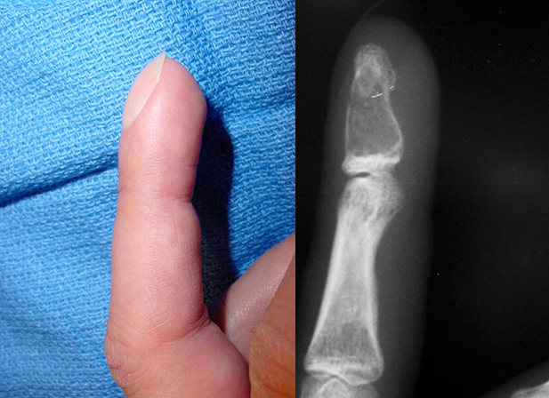 Distal Phalanx Enchondroma with cortical thinning and distal phalanx expansion