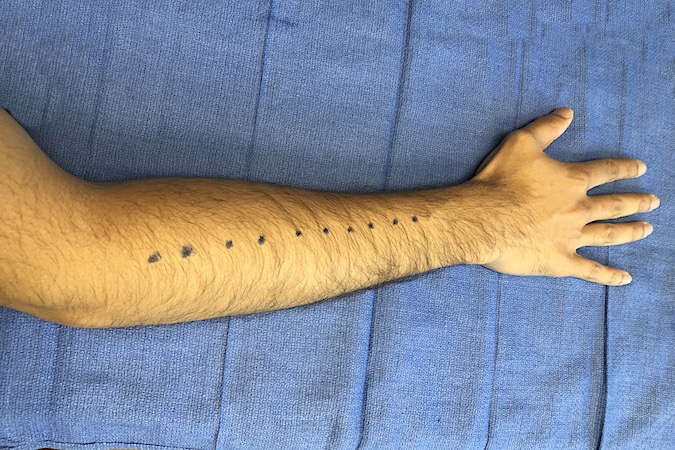 Dorsal Incision plan for dorsal forearm fasciotomies