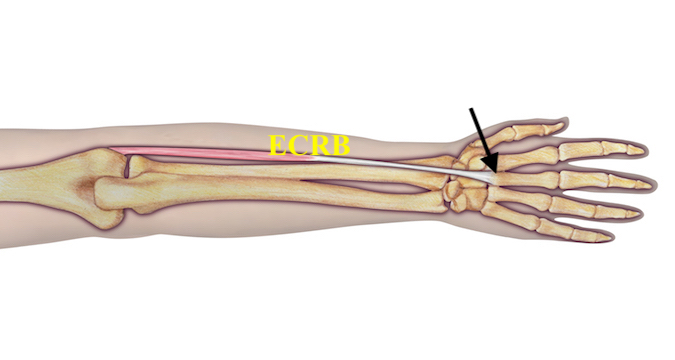 Site of ECRB avulsion (arrow)