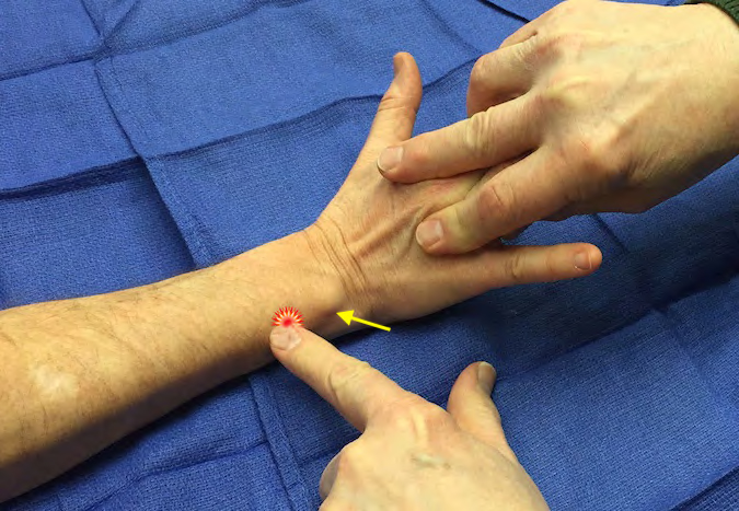 Extensor Carpi Ulnaris (ECU) Tenderness | Hand Surgery Resource